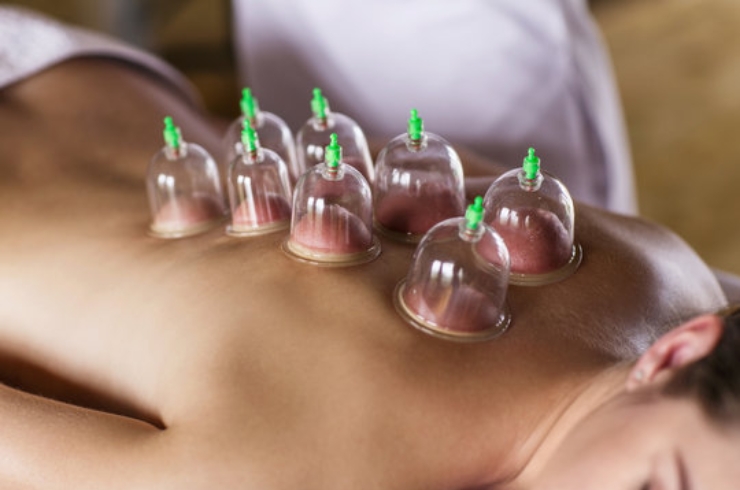 Cupping therapy including dry cupping------15