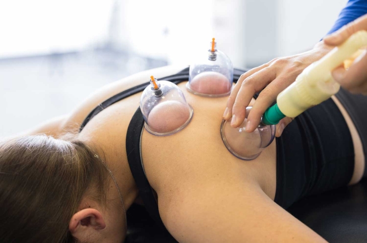 sports cupping for injury recovery------14